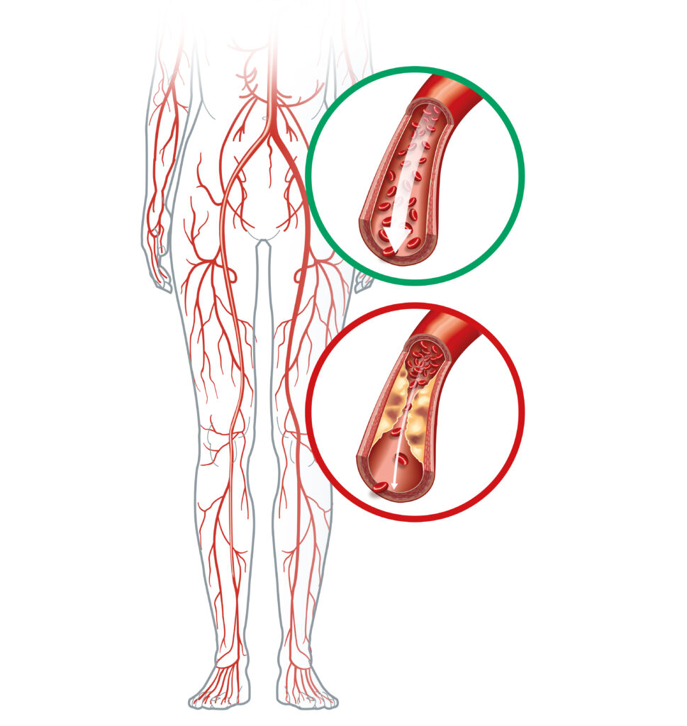 Vascular Rarea What is Vascular Disease - Vascular society of India