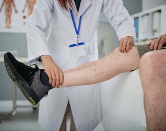 Varicose Vein