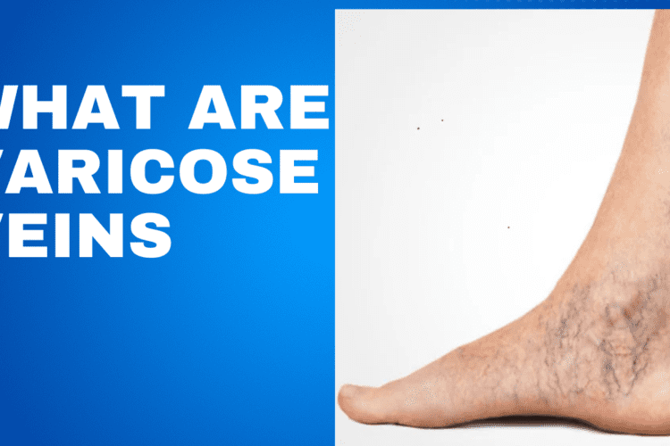 what are varicose veins