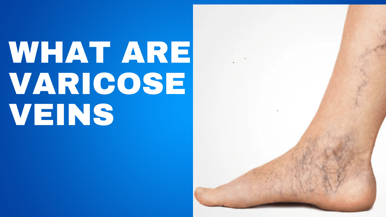 what are varicose veins