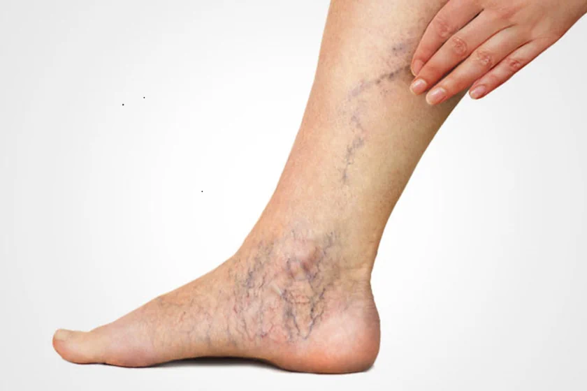 what is varicose veins